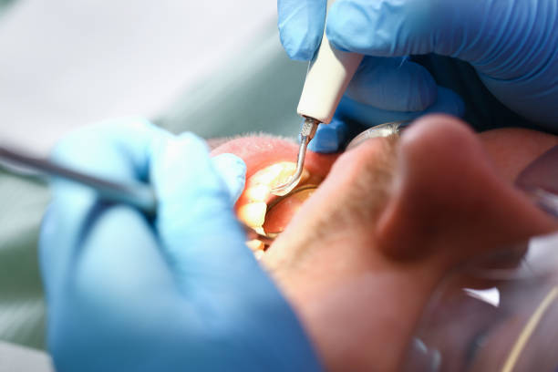Best Emergency Dentist for Lost Fillings or Crowns in Pleasant View, UT